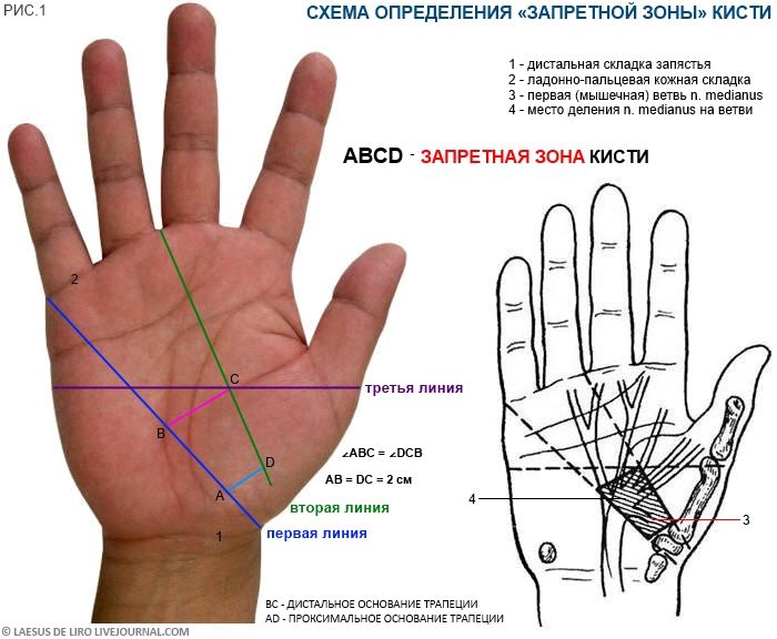 Схема определения "Запретной зоны" кисти (Канавелла)